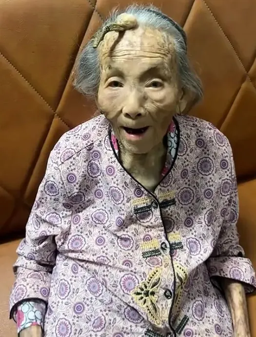 107 Year Old Woman Thrives With A 4 Inch Longevity Horn On Her Forehead