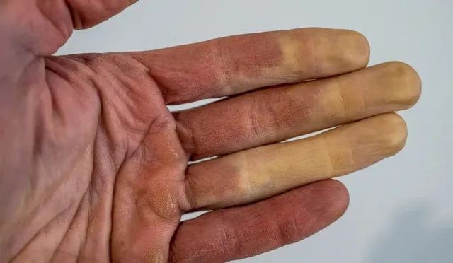 why your fingers change color in cold winter months 12516