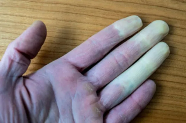 why your fingers change color in cold winter months 12515