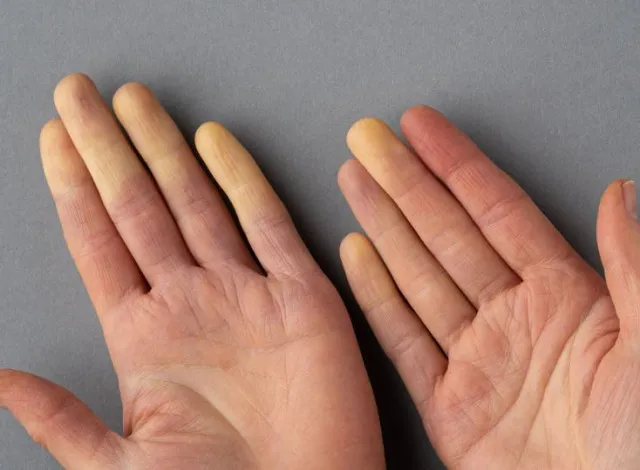 why your fingers change color in cold winter months 12513