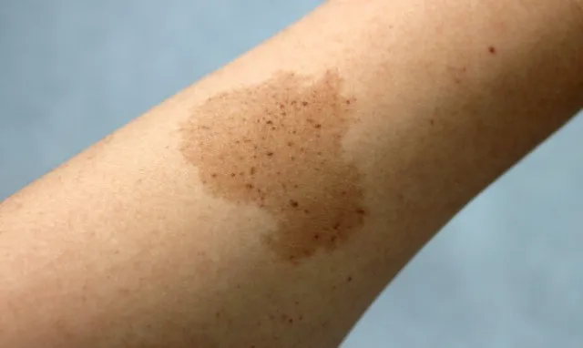 could our birthmarks be evidence of past life experiences? 13472