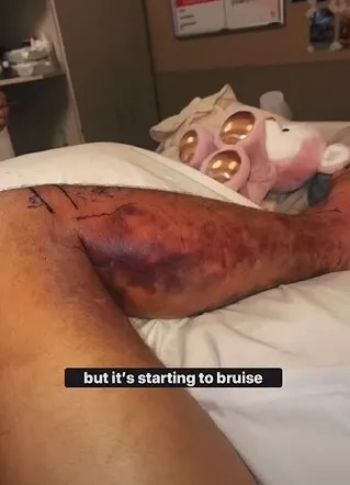 influencer nearly loses life after live-streaming himself being bitten by v 13674