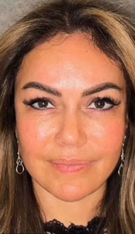 woman reveals how eye color change surgery from brown to blue changed her l 13885