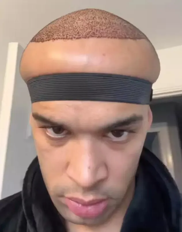 man leaves people chilled by shocking results from hair transplant at celeb 15299