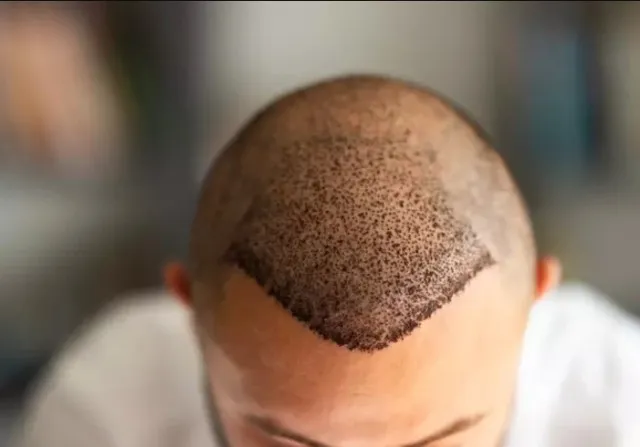 man leaves people chilled by shocking results from hair transplant at celeb 15300