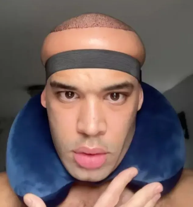 man leaves people chilled by shocking results from hair transplant at celeb 15298