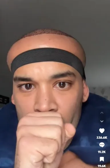 man leaves people chilled by shocking results from hair transplant at celeb 15301
