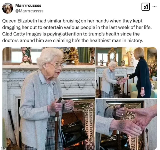 people scared as they compare the bruise on trumps hand to queen elizabeth 18171