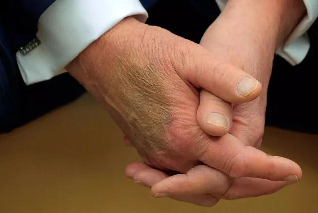 white house responds after bruise on trumps hand sparks health concerns 18151