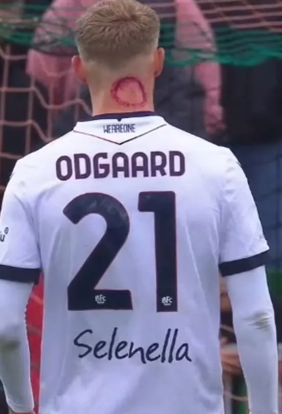 footballer breaks silence on ‘zombie bite’ claims after viral injury photos 20934