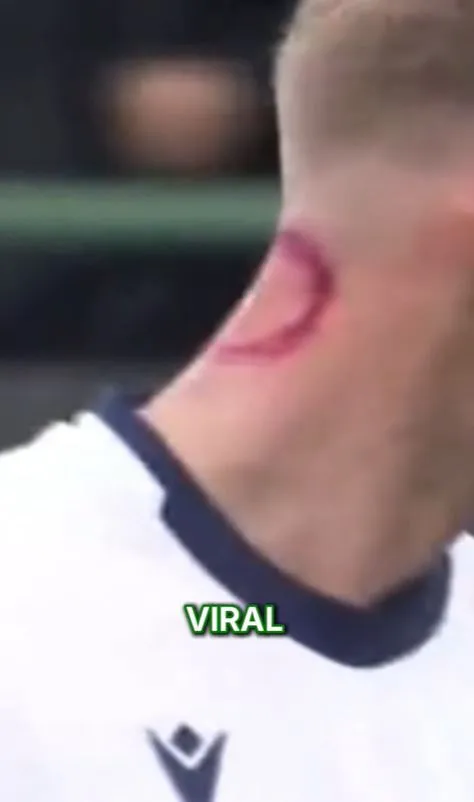 footballer breaks silence on ‘zombie bite’ claims after viral injury photos 20932