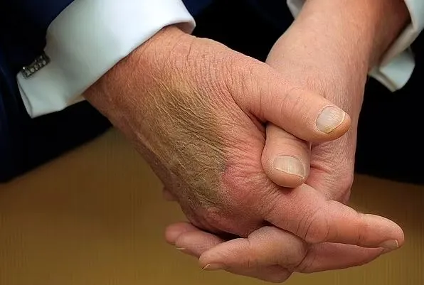 people stunned after spotting mysterious bruise on donald trumps hand spar 22233